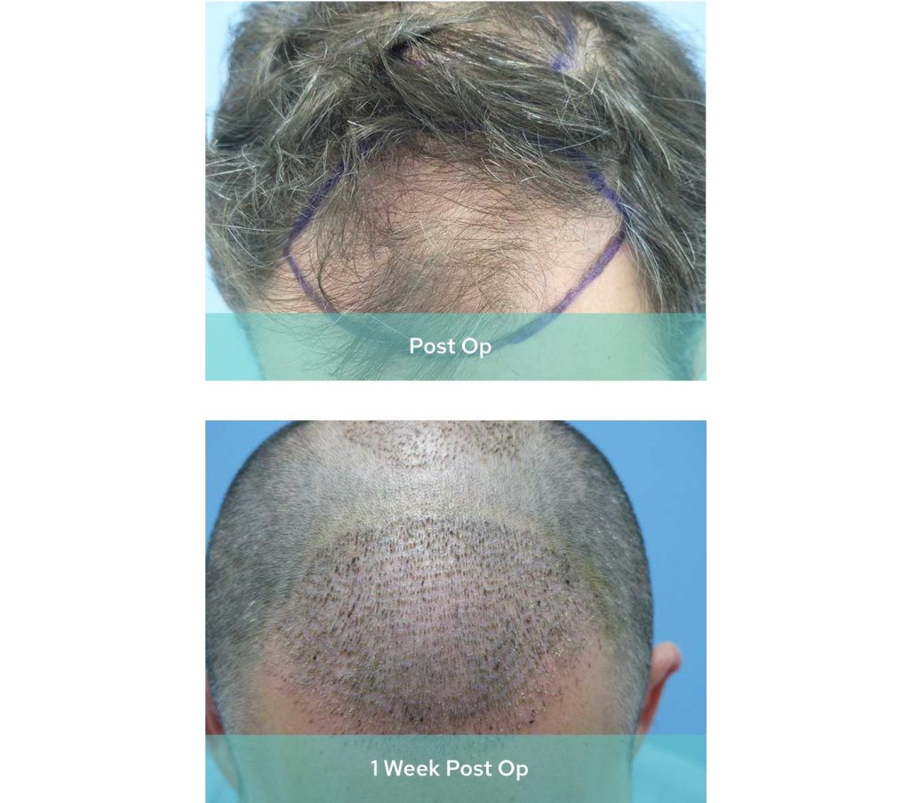 1 Week Post Op Male Hair Transplant