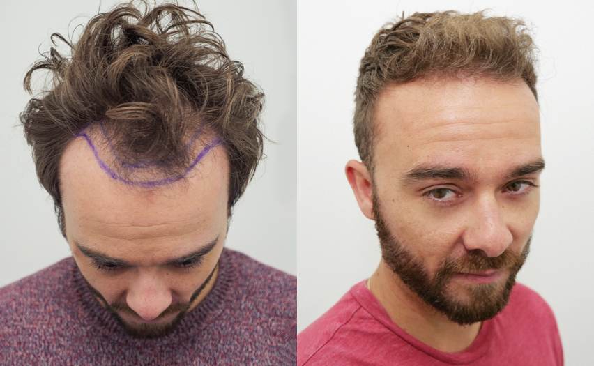 Picture of Jack P Shepherd before & after his hair transplant